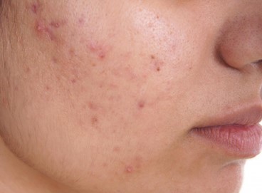 Leia mais sobre o artigo Acne provocada pelo uso de máscara contra Covid-19 turbina venda de produtos de pele