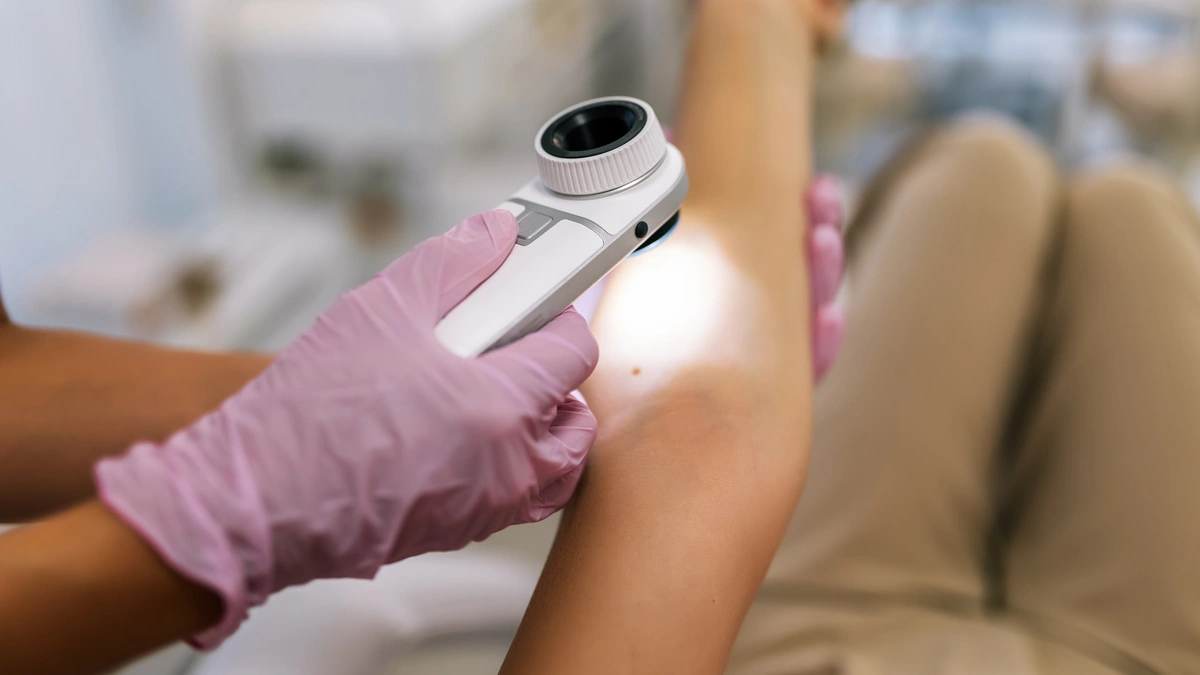 No momento, você está visualizando Raios UV causam 80% dos melanomas no mundo, segundo agência da OMS