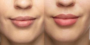 Leia mais sobre o artigo Conheça o primeiro batom do Brasil com microplastia que preenche profundamente os lábios